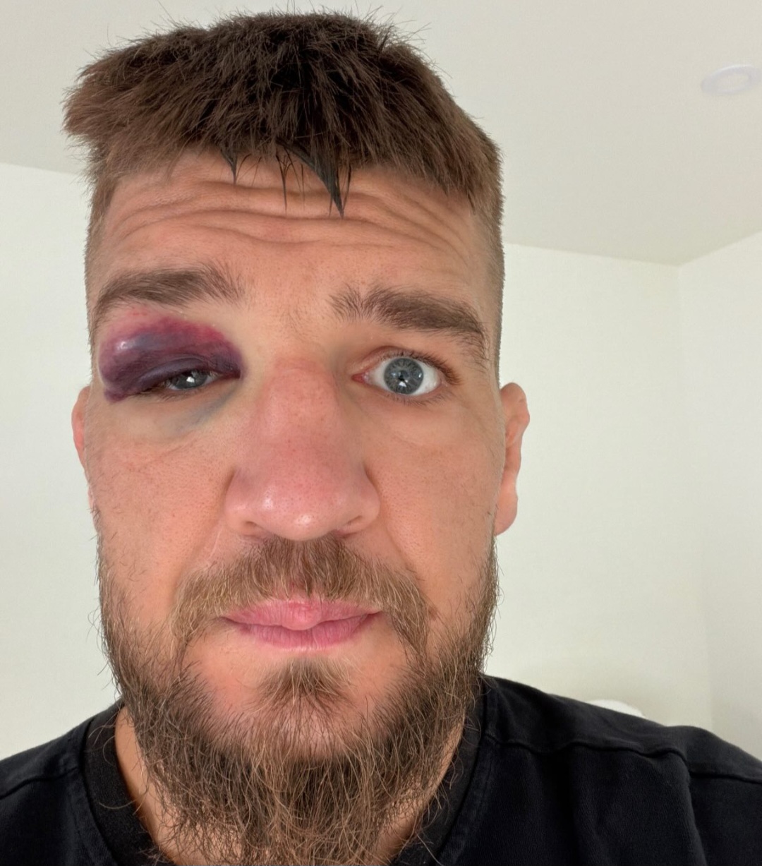 ياروسلاف أموسوف يكشف إصابة مرعبة قبل UFC 328: ظننت أن الأمر غريب!